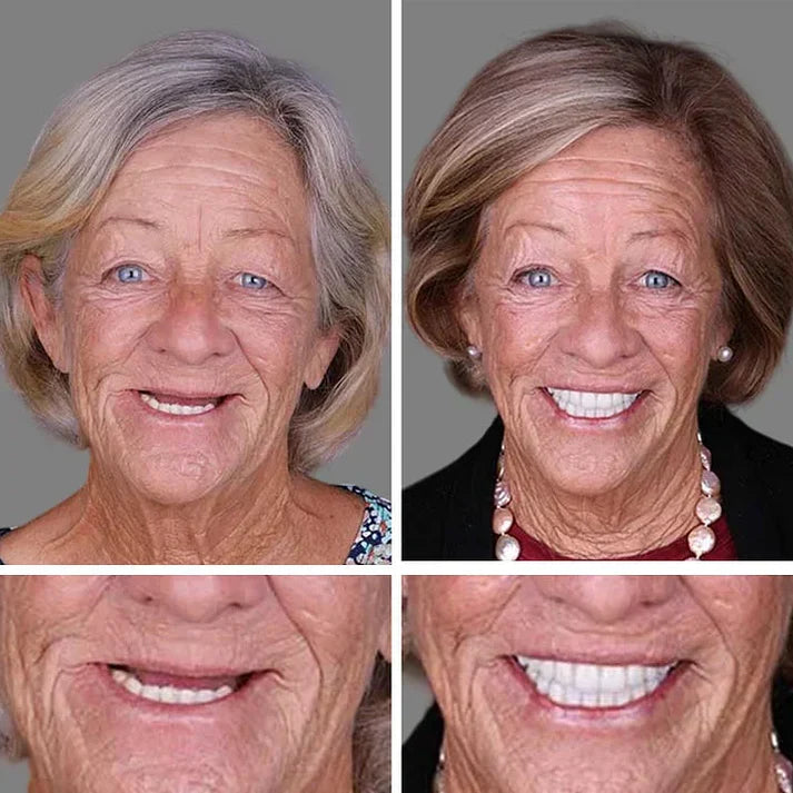🌎Ends Today: 70% OFF! ⏰ Medical Full Denture with Strong Suctiond🦷Obtain American Dental Association (ADA) Certification